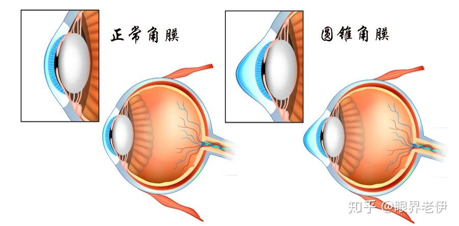 角膜交联术解密圆锥角膜与角膜交联手术