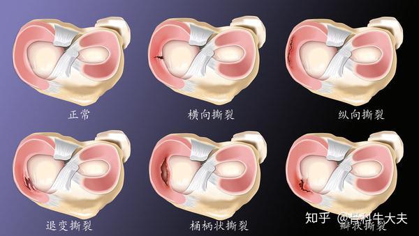 总结:半月板损伤只有少数情况才需要手术治疗,主要是位于白区(红白区)