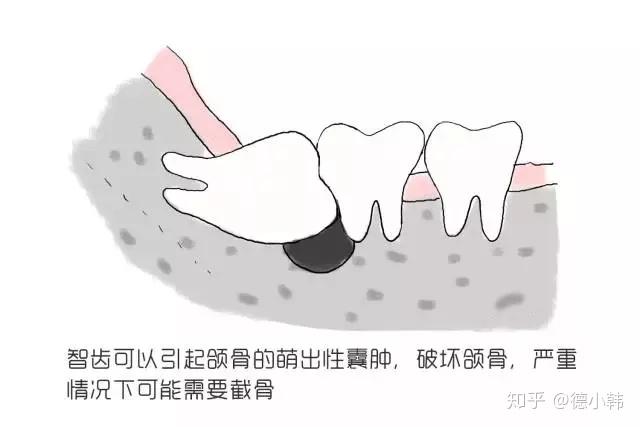 智齿牙骨质增生,可以引起牙根肥大, 拔的越晚,可能越不好拔.
