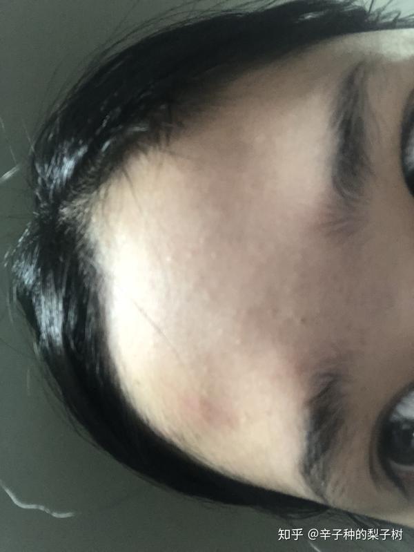 脸上长了很多又红又痒逆光疹子有些透明的尖头看起来油油的脂溢性皮炎