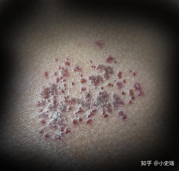 带状疱疹痒吗 zhuanlan.zhihu.com