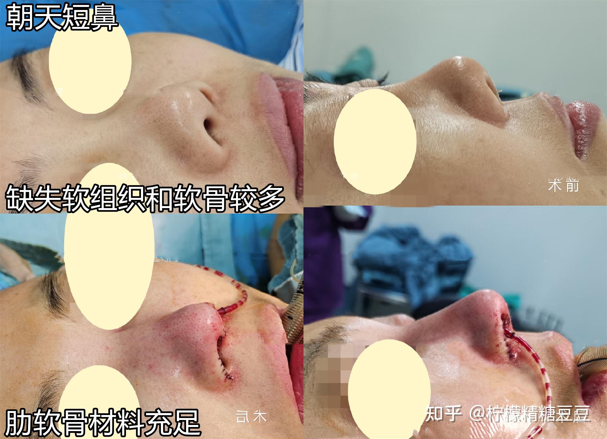 硅胶隆鼻透光怎么办膨体隆鼻感染怎么办肋软骨隆鼻太贵怎么办小白如何