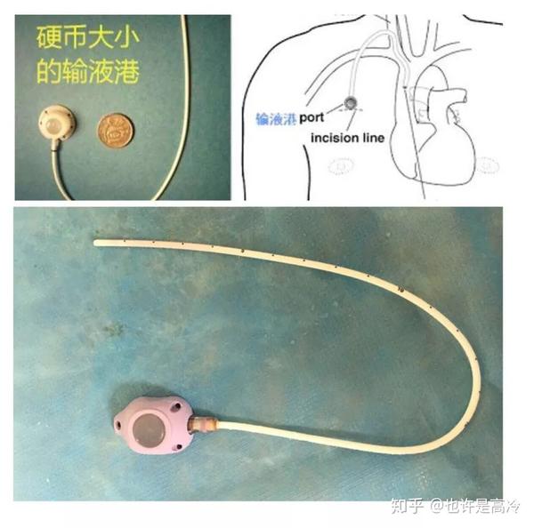 输液港进医保吗 医保输液港