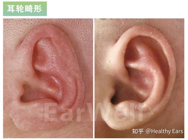 【一问一答】哪些耳廓畸形可以耳模矫正?