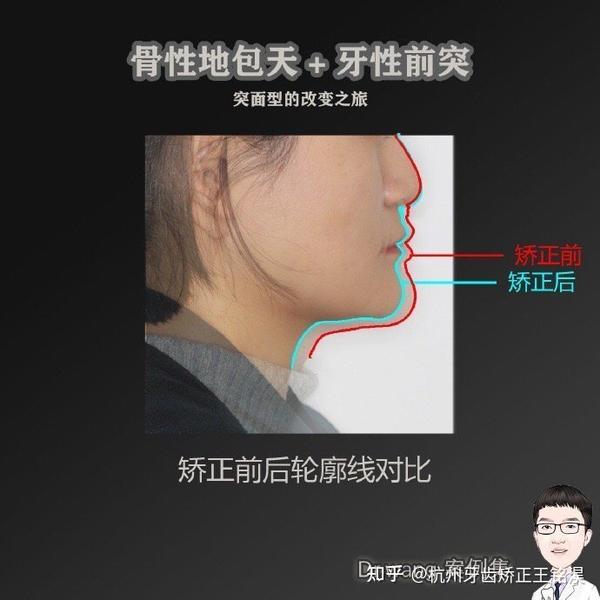 杭州牙齿矫正丨初步自查骨性,牙性前凸