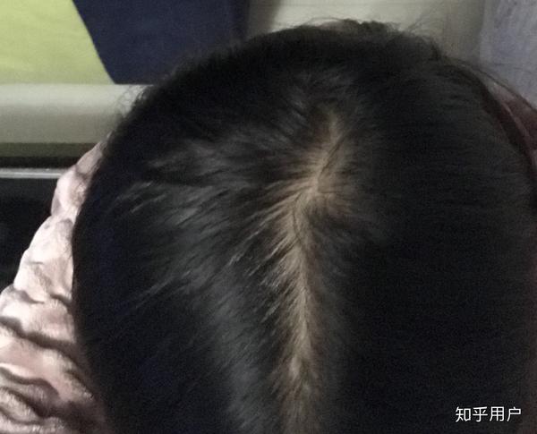 女生秃顶是怎样一种体验?