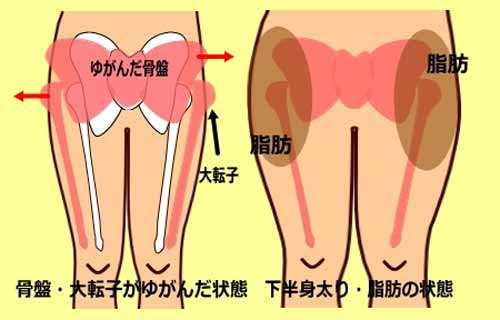 臀部两侧凹陷是因为臀中肌不发达吗?