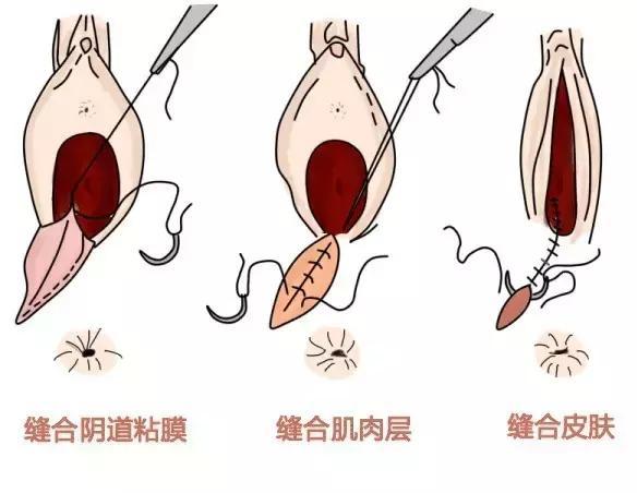 需要在产后第4天拆线;如果用的是可以被人体吸收的缝合