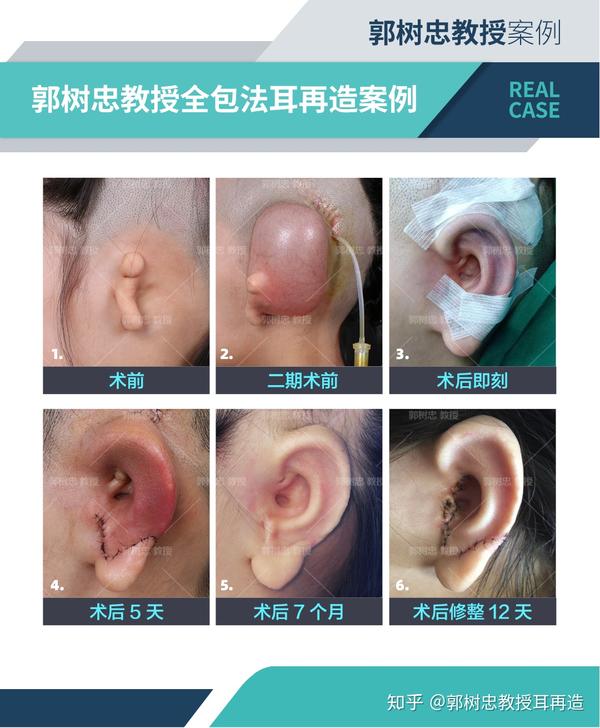 耳再造手术的细节(8)耳再造手术拆线的时间为什么要慢