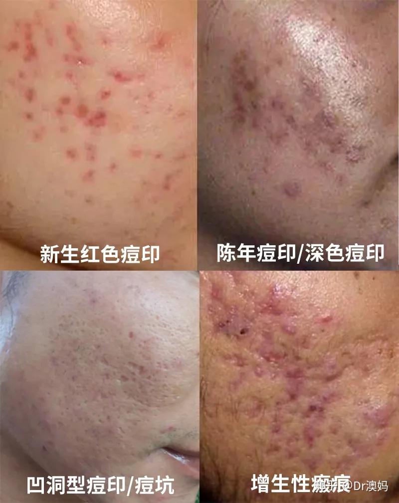 我们上两集讲过4种痘印的类型:今天这篇坑及填坑指南视频可能会揭露