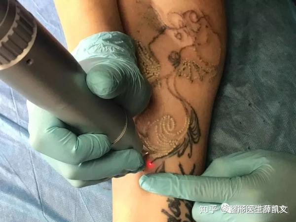 文身洗了四次没有成功,最后选择了手术切除?