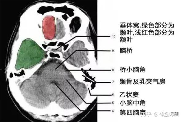 解剖影像颅脑ct解剖口诀及彩色解剖图