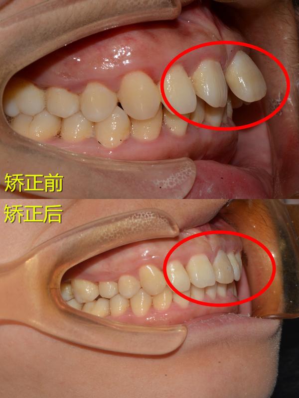 重庆牙齿矫正:牙列不齐,牙周炎,门牙缝隙大 牙周刮治