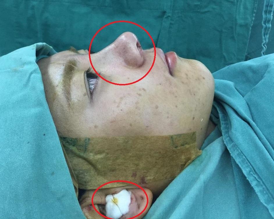 那么肋软骨隆鼻究竟难在哪里呢?