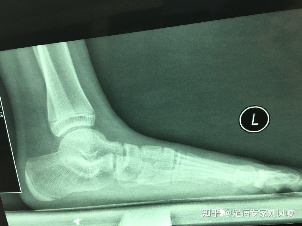 儿童脚疼的常见原因却被经常漏诊的问题北京和平里中西医结合医院骨科
