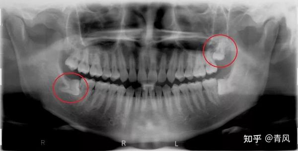 右上的智齿应该是高位垂直阻生,这种牙齿拔牙一般不会有什么难度. 2.