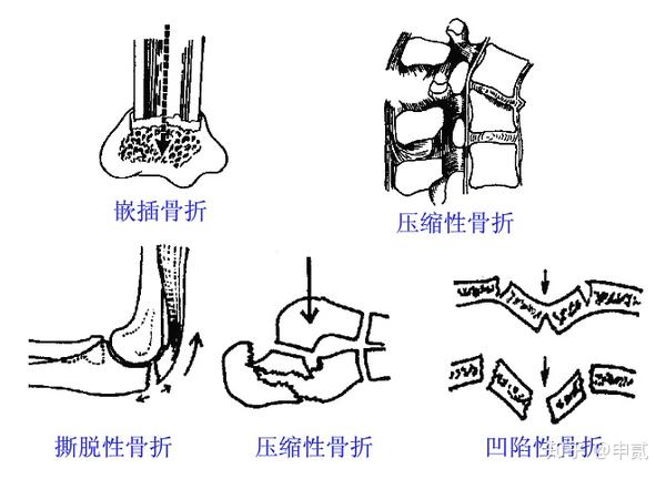 根据骨折端稳定程度分类  稳定性骨折:裂缝骨折,青枝骨折,横形骨折