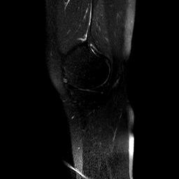 请问mri影像看出来确定是半月板损伤吗?(附mri)?