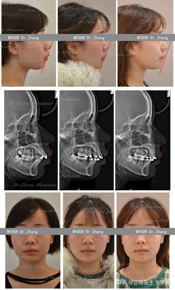 骨性或者骨性 牙性龅牙是否要做正畸?龅牙矫正脸型改变有多大?