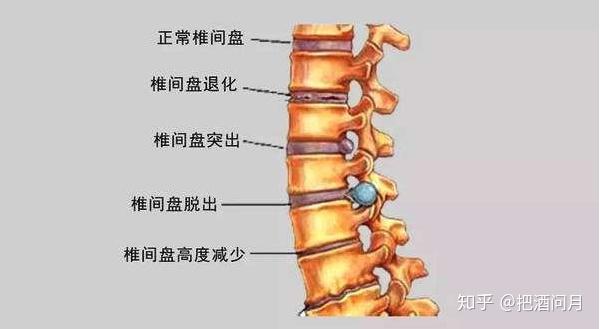 如何预防腰椎间盘突出怎么锻炼方法腰椎间盘突出锻炼方法