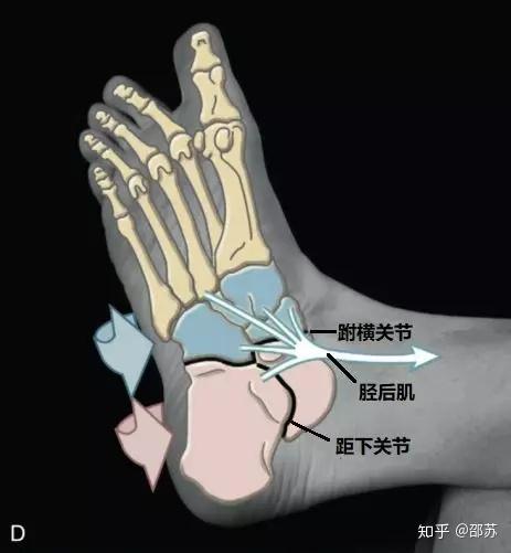 足底足跟痛小心足内翻