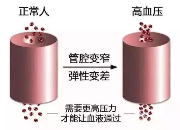 测血压随时查高血压有讲究