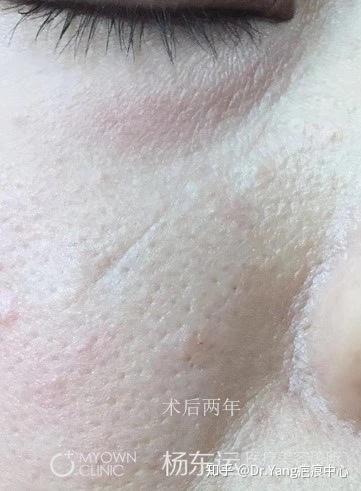 一例面部不规则条状凹陷疤痕切缝案例