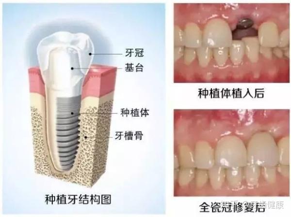 口腔科普丨牙齿掉了但是牙根还在该怎么办