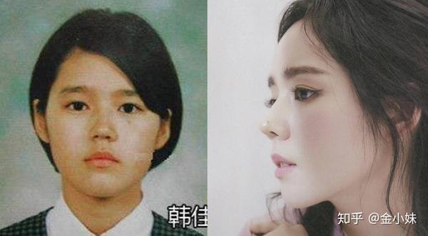 为什么杨幂和娜扎都整了鼻子,正面还是露鼻孔,原来问题出在了这里.