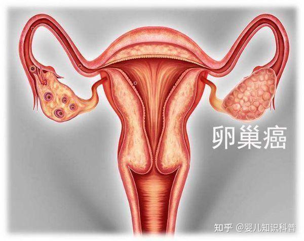 保护子宫内膜的5个好方法
