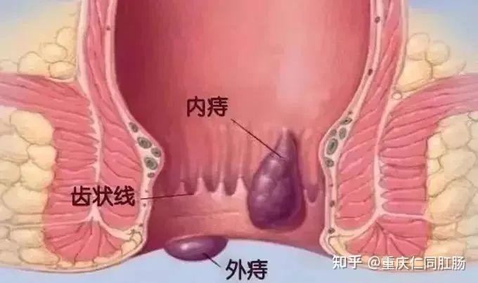 重庆哪些医院肛肠科比较好?患了痔疮,为什么有的人不疼?有的人的疼?