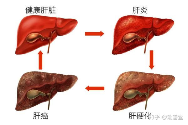 67治好了肿瘤却坏了肝吃药引起的肝损伤要怎么办