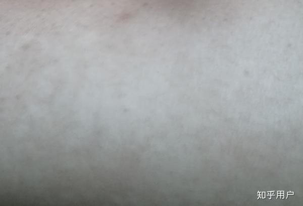 不是白癜风就是黑色素减退斑.这个我也有医生说没有什么好的办法.