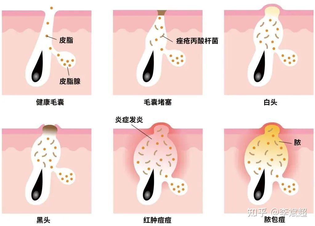 如果痤疮丙酸杆菌再来作祟,炎症反应加剧,痘痘就会变红变肿,随后