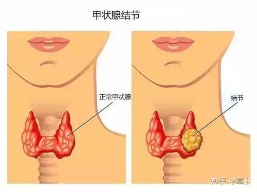 体检报告上"甲状腺结节",不会是癌症吧?