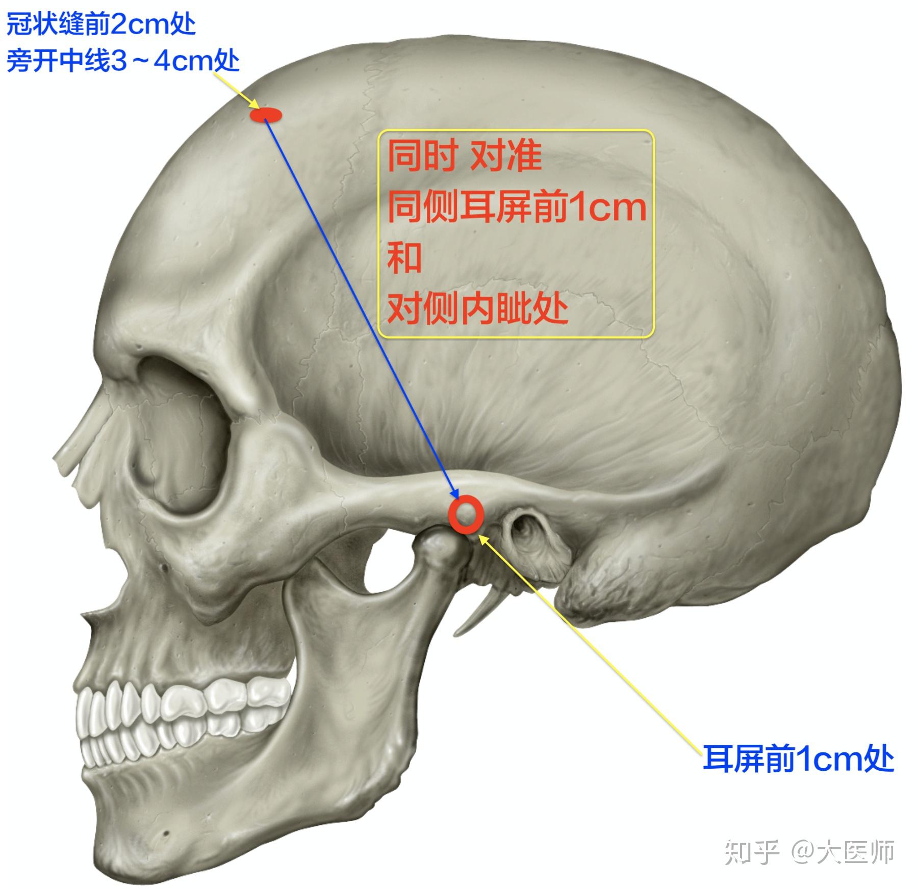 侧脑室前角穿刺