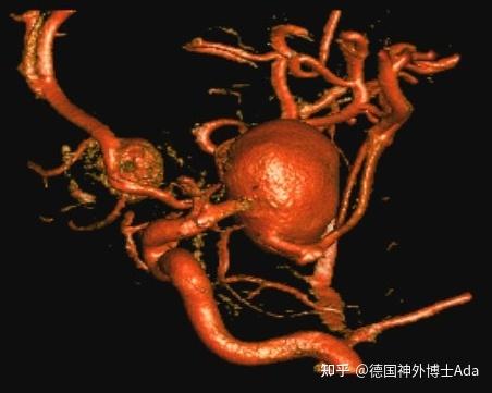 巨大脑动脉瘤能安全手术吗