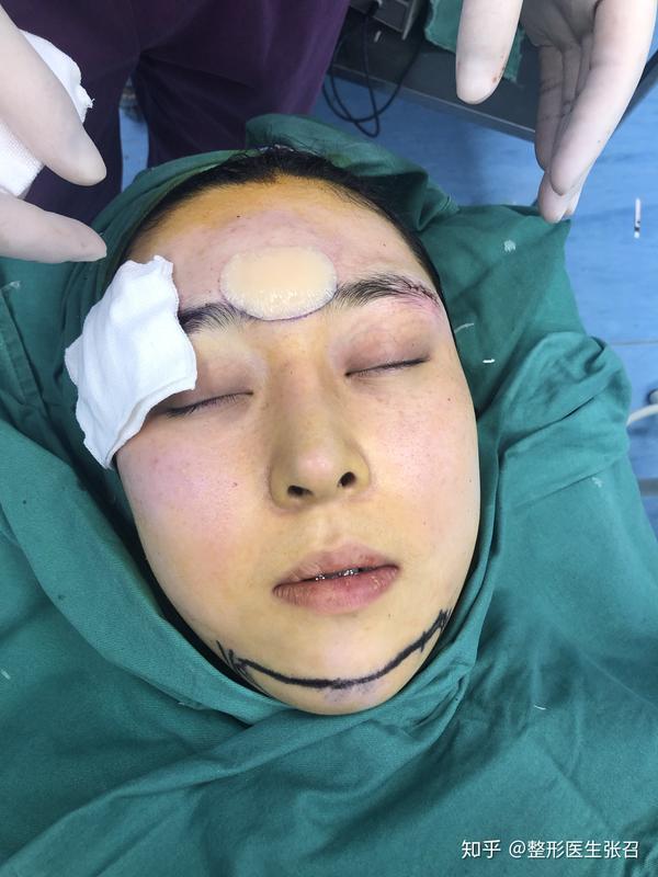 眉心假体填充