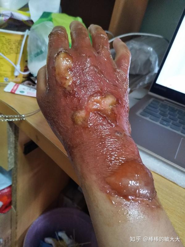 烫伤之后怎么做不会留下疤痕?