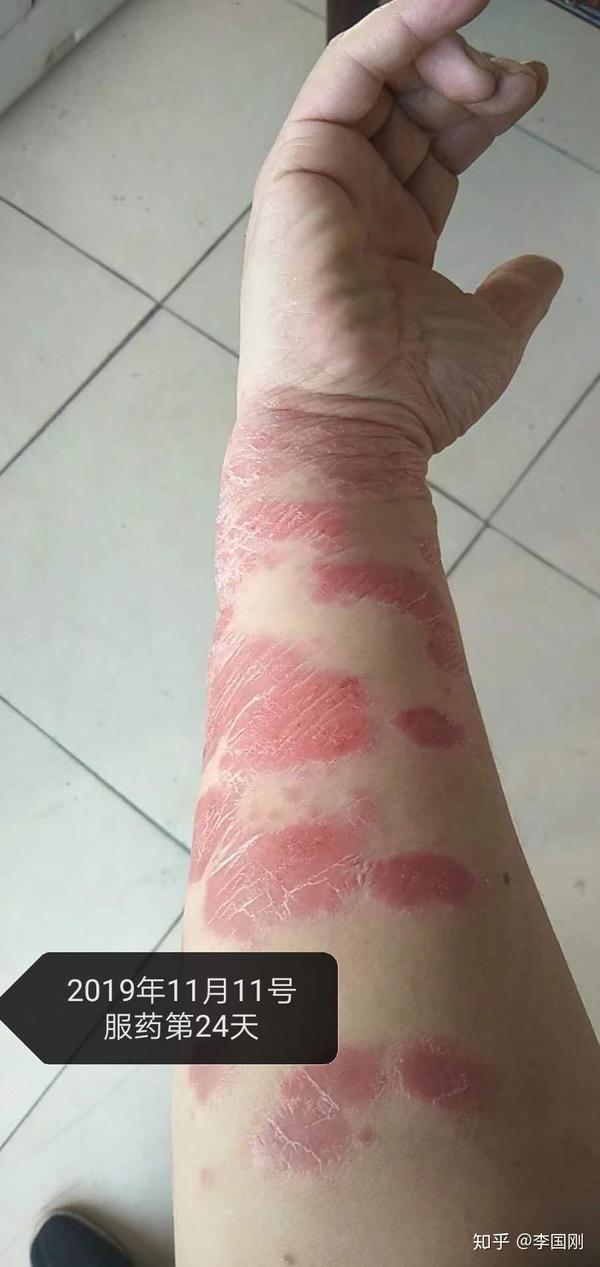 手臂块状银屑病消退顺序图片(山东.滨州)