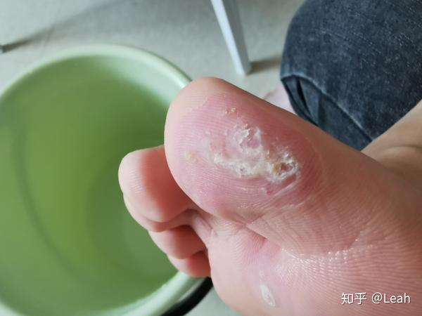 阿司匹林治跖疣有图慎入