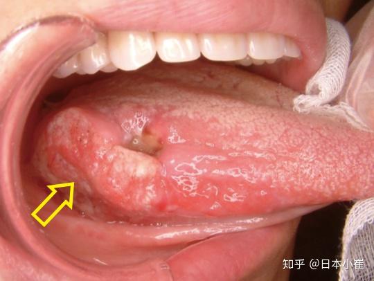 其他原因包括口腔卫生不洁,假牙畸形,牙齿尖锐和人乳头瘤病毒(hpv)