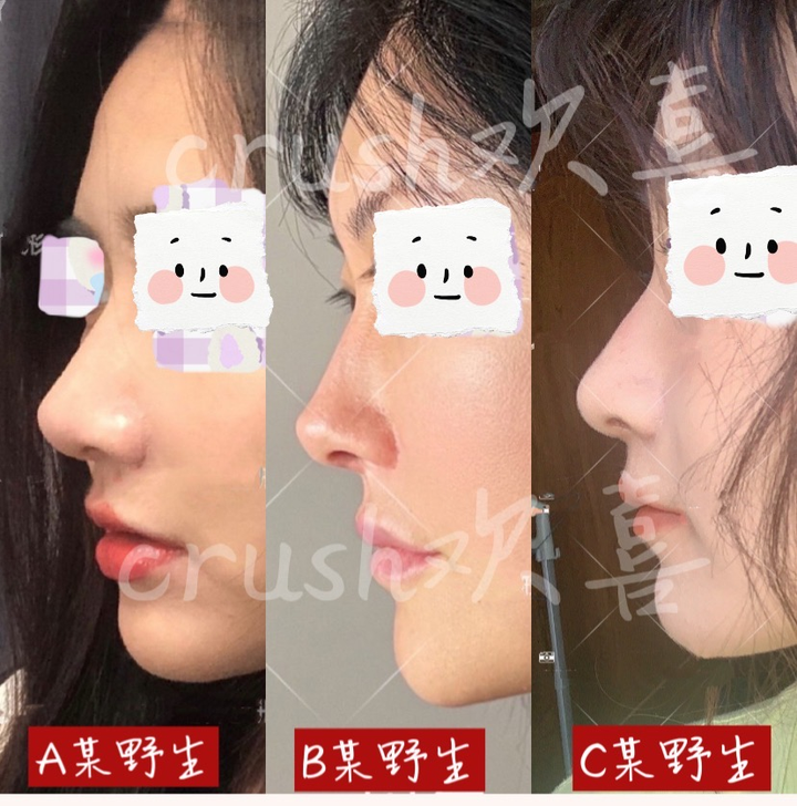 杭州隆鼻专家推荐自然技术审美好的