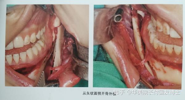 下颌角外板截除术