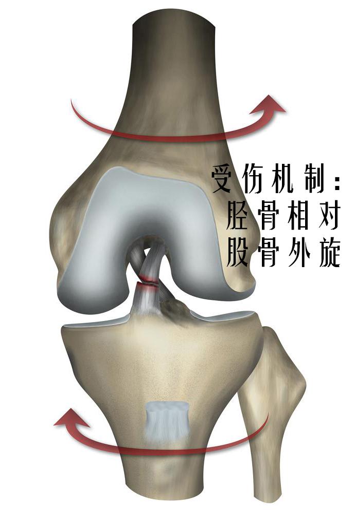 前交叉韧带撕裂了该怎么办