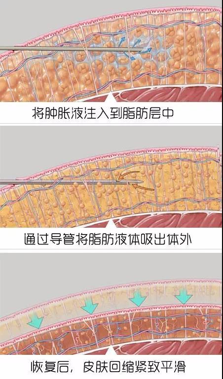 那么吸脂后到底可不可以看到明显的瘦身效果呢