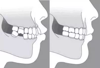是我们下颌骨的发育状况与牙齿咬合关系 如果按照人的侧面骨相区分