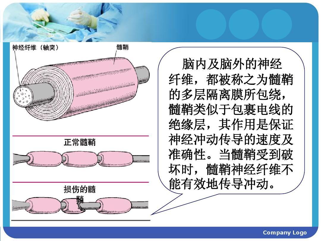 什么是脱髓鞘脑白质脱髓鞘