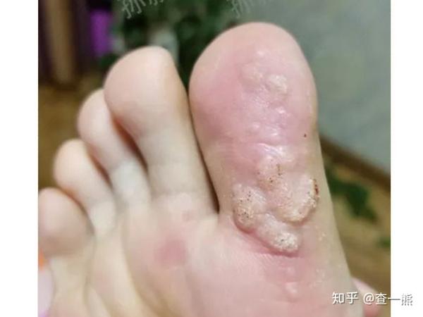 在详细的沟通了解后,牵挂(化名)和孩子报以热忱重新踏上 除疣恢复的