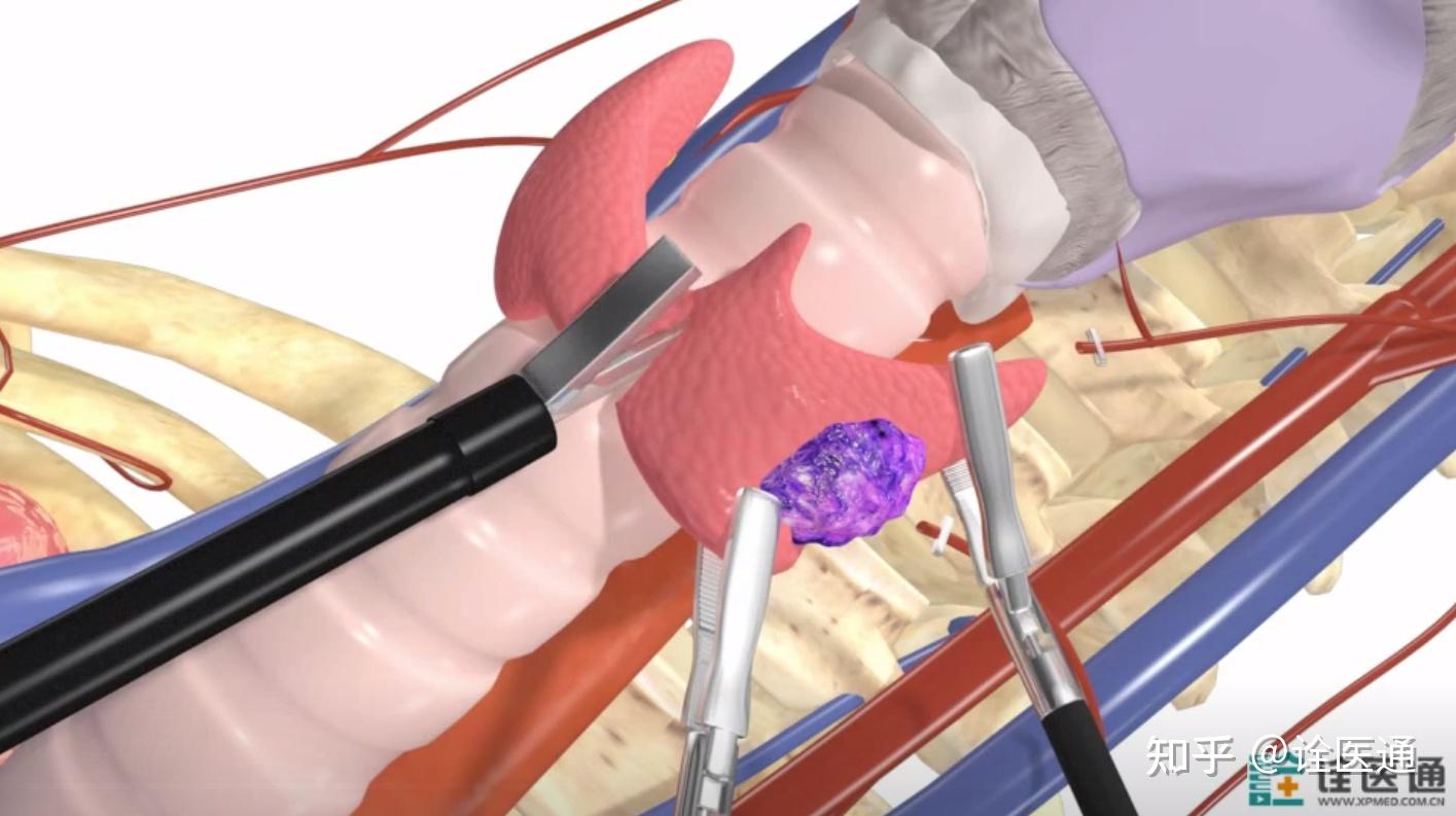 通过腋下就可以切除甲状腺肿物